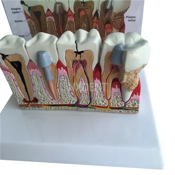 1 бр. Стоматологичен Анатомический Зъб Модел на Зъбите Анатомическая Модел на Зъбите Негабаритная Анатомия Разрушен Зъб Демонстрация на Комуникация